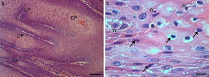 Grade I squamous cell carcinoma (A) Micrograph of grade I squamous carcinoma cells, with the presence of diffuse keratin pearls (CP) (HE, bar=100μm). (B) Micrograph of grade I squamous carcinoma cells with various apoptotic cells with condensation of cytoplasm (arrows) and anoikis (*) (HE, bar=10μm).
