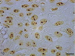 Grade II squamous carcinoma cells with AgNORs. Micrograph of grade II squamous cell carcinoma containing AgNORs forming rounded clumps filling the entire nucleolus or as small satellites scattered by the nucleus (AgNOR, bar=10μm).