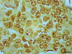 Grade III squamous carcinoma cells with AgNORs. Micrograph of grade III squamous carcinoma cells with AgNORs forming dark clumps together and occupying the entire nucleolus or isolated as small satellites in large nuclei (AgNOR, bar=10μm).