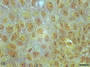 Papilloma with AgNORs. Micrograph of papilloma with AgNORs forming small clumps present in the nucleus as satellites or occupying the entire nucleolus (AgNOR, bar=10μm).