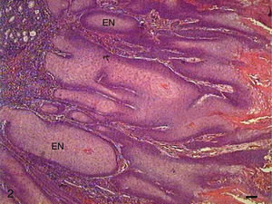Grade I squamous cell carcinoma. Micrograph of grade I squamous cells, with invasion of connective tissue by tumor cells in the form of very delimited epithelial nests (EN) (HE, bar=100μm).