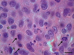 Grade II squamous carcinoma cells. Micrograph of grade II squamous carcinoma cells with presence of apoptotic cells with condensation of cytoplasm (arrows) and anoikis (*) (HE, bar=10μm).