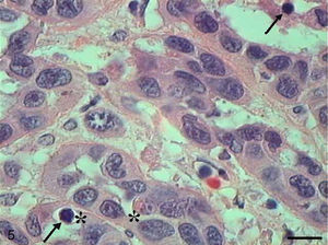 Grade III squamous carcinoma cells. Micrograph of grade III squamous carcinoma cells with apoptotic cells with nuclear hyperchromatacism (arrows) (HE, bar=10μm).