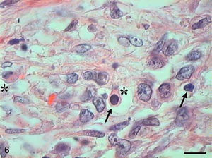 Grade III squamous carcinoma cells. Micrograph of grade III squamous carcinoma cells with presence of a few apoptotic cells with condensation of cytoplasm (arrows) and anoikis (*) (HE, bar=10μm).