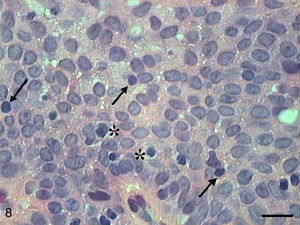 Papilloma. Micrograph of papilloma with cell apoptosis with condensation of cytoplasm (arrows) and anoikis (*) (HE, bar=10μm).