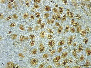 Grade I squamous carcinoma cells with AgNORs. Micrograph of grade I squamous carcinoma cells with AgNORs in the form of isolated lumps or forming large aggregates, with rounded or irregular shapes filling the entire nucleus or present in the nucleolus as satellites (AgNOR, bar=10μm).