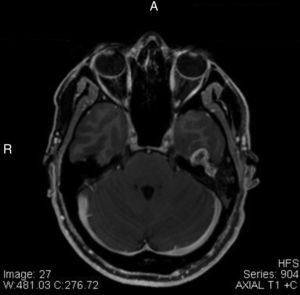 Axial T1-weighted magnetic resonance imaging with contrast showing lesion located next to the geniculate ganglion and tympanic portion of the facial nerve to the left.