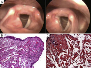 (A) Telelaryngoscopy: bulging in the right vestibular fold, without glottic or subglottic involvement. (B) Fragment showing respiratory-like epithelium with mild lymphomononuclear infiltrate in the stroma and apparent deposition of amorphous eosinophilic material at hematoxylin-eosin staining, in the outlined space (H&E, 200×). (C) Same area shown in B with paler appearance than the rest of the sample, when stained with Congo red (Congo red, 400×).