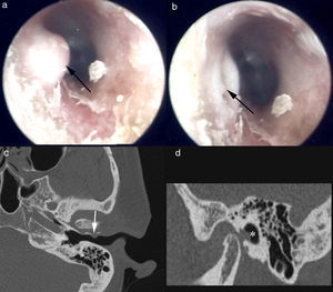 Otoendoscopic findings showing the protrusion as a dome-shaped mass when the mouth was closed (a), and retracted when the mouth was open (b). The axial (c) and sagittal (d) high-resolution computed tomography showed a bone defect of the anterior wall of the external auditory canal (arrow) with herniation of soft tissue material (asterisk).