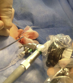 ALL being performed with the optical device in position, reflux needle and triangulation for instrumentation.