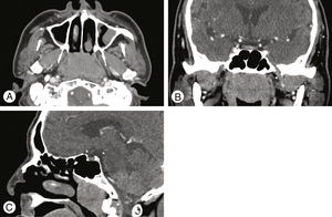Computed tomography (CT) of paranasal sinus. Contrast-enhanced CT images show a bilateral, homogenous, mildly-enhanced solid mass from nasopharynx extending to upper oropharynx on axial (A), coronal (B), and sagittal (C) view.