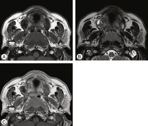Magnetic resonance (MR) images of nasopharyngeal mass. Bilateral nasopharyngeal mass reveals low signal intensity on T1-weighted image (T1WI) (A) and intermediate signal intensity on T2WI (B). Postcontrast image (C) demonstrates moderate enhancement.