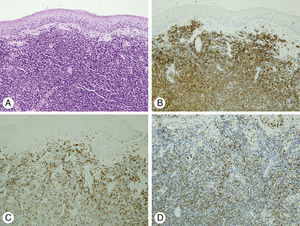 Histopathologic findings of nasopharyngeal mass. (A) Microscopic finding shows diffuse infiltration of small lymphocytic cells with mild nuclear atypia (H&E, ×200). Immunohistochemical staining shows strong positivity to anti-CD20 (B), anti-CD5 (C), and anti-cyclin D1 (D) antibody (×200).
