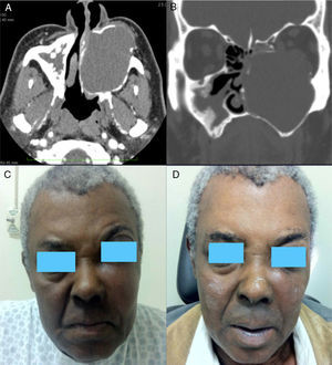 (A) Computed tomography (CT) (axial section), showing an expansive lesion occupying the entire left maxillary sinus and promoting remodeling of bone limits. (B) CT (coronal section), showing an extension of the lesion to the orbital cone. (C) Preoperative picture showing bulging of the malar area and proptosis (left side). (D) Postoperative photography showing a clear improvement of bulging and proptosis.