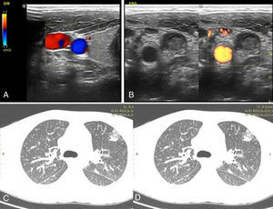 (A) Right cervical doppler ultrasound scan with normal vascular flow. (B) Flow absent in left internal jugular vein. (C) Computed tomography of chest; lung parenchyma showing multiple nodes. (D) Ground-glass appearance in lung bases.