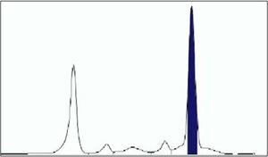Serum electrophoresis showing a homogeneous narrow peak and a dense band in the gamma region.