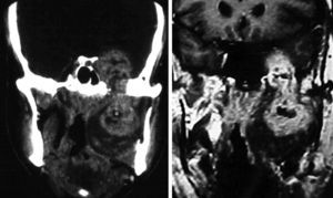 Mandibular nerve schwannoma: coronal computed tomography and magnetic resonance imaging show a hourglass-like mass with a localized shaft and widening of the oval foramen, with intracranial components and in the masticator space.