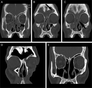 (A–C) Preoperative coronal computed tomography (CT) scan showing: (A) a hyperdense mass occupying both nasal cavities and the bilateral frontal, bilateral ethmoid, and bilateral maxillary sinuses; (B) the well-pneumatized frontal sinus, destruction of the frontal sinus septum, a bone septum on the lateral wall of the left frontal sinus (black arrow), and a slight deviation of the nasal septum to the right; and (C) the enlarged frontal ostium and focal hyperostosis in the left ethmoid sinus (black arrow). (D and E) Postoperative coronal CT scan after complete removal of the mass. There was no sign of recurrence two years after surgery.