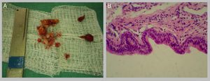 (A) The fragmented stone is seen on the left. On the right side, there is a tissue corresponding to the salivary cyst. (B) Histological section of the cyst showing oncocytic epithelium compatible with ductal epithelium (hematoxylin and eosin stain, 400×).