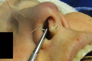 Intercrural medial suture. Step 1 – passage with a 5mm curved needle above the base of columellar pocket to the external aspect.