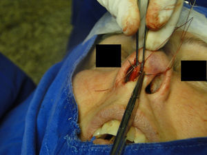 Nasal tip rotation suture. Step 4 – the needle is trespassed 5mm behind and below the nasoseptal angle.