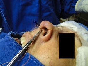 Intercrural medial suture. Step 3 – through the same orifice, the needle returns to the interior of the pocket.