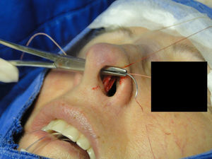 Intercrural medial suture. Step 4 – passage of the needle to the side where the suture began.