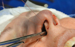 Intercrural medial suture. Step 5 – tying three fixation knots.