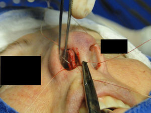 Intercrural medial suture. Step 6 – passing the point through septal cartilage, 5mm posterior to the caudal rim.