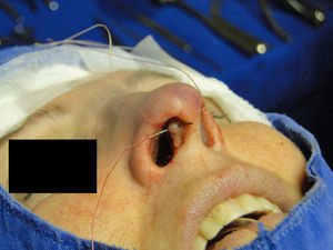 Nasal tip rotation suture. Step 1–5mm below the apex of the columella, the needle is passed from the pocket to the external aspect.