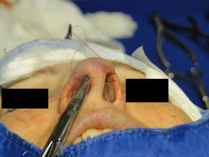 Nasal tip rotation suture. Step 2 – the needle returns through the same orifice to the opposite side, at the same level.