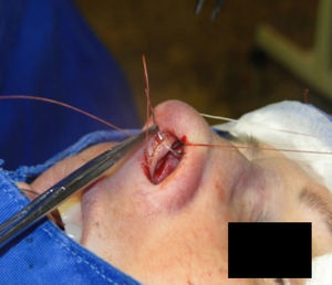 Nasal tip rotation suture. Step 3 – through the same orifice, the needle returns to the pocket.
