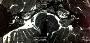 T2-weighted axial MRI before radiotherapy, showing an expansive lesion measuring 1.0cm×0.7cm×0.7cm and occupying the right internal auditory canal (T1 according to the classification of Hannover) and another injury of the same kind measuring 2.0cm×1.2cm×0.7cm on the left (Hannover T3a).