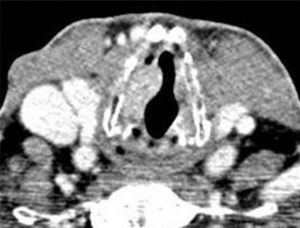 Contrast-enhanced computed tomography demonstrates an enhancing right laryngeal mass deeply located in the vocalis muscle.