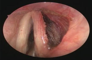Endoscopic view after the removal.