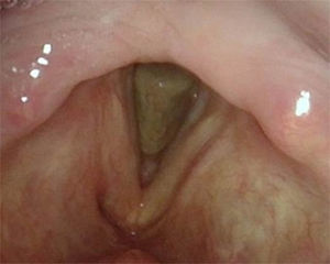 Indirect laryngoscopy at 12 months after surgery.