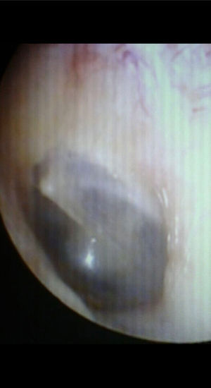Tympanic membrane after application of bacterial cellulose graft, on microscopic examination.