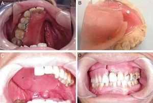 (A) View of defects before definite rehabilitation; (B) image of tissue surface of obturator and magnetic attachment; (C) set-up of obturator; (D) intraoral view of the denture.