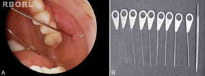 Papilla catheterization of a left parotid gland (A) and probes utilized to perform papilla dilation (B).