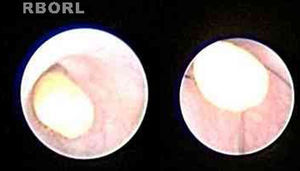 Sialendoscopic view of a stone and its removal with mini basket catheter.