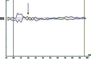 Example for Category 2 (Cochlear Microphonic pattern without ABR threshold).