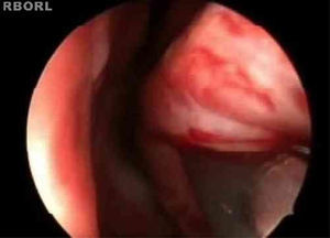 Incision line on the inferior turbinate (endoscopic view).