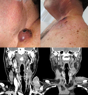 Case 1: External aspect and CT-scan of a lower left cervical mass prior (left images) and after four weeks (right images) of the electrochemotherapy.
