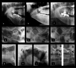 Radiographic assessments of different TMDs. (a–c) Close-up in panoramic image showing mandibular condyle hypoplasia (a), horizontal impaction of the third molar (a, b) fracture line in the region of gonial angle (b) and elongated styloid process. The transcranial images (d–f) show the presence of osteophytes (d), preservation of joint spaces in maximum habitual intercuspation (MHI) (e) and the identification of condylar hyperexcursion (f). The planography techniques (g–j) demonstrate: mandibular neck fracture and ankylosis (g) elongated styloid process (h), advanced remodeling process, superior-anterior flattening, cortical irregularities, and osteophyte formation (i) in addition to mandibular head hyperexcursion, defining TMJ hypermobility (j).