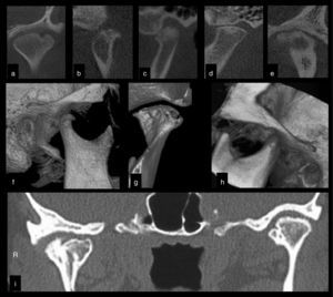 Cone-beam computed tomography (CBCT) assessment of different TMJs in the coronal (a, e) and parasagittal (b–d) views. (a) Coronal view showing extensive erosion. Note the presence of bone sclerosis, cortical irregularities, and osteophytic formation in (b), (c), and (e). The presence of subchondral cysts can be observed in (c) and (e). Advanced flattening of bone components and decreased joint space are recorded in (d). Advanced degenerative osteoarthritis alteration is observed in e. Three-dimensional reconstructions (f–h) show osteophytes (f, g), advanced erosion (g) and hyperexcursion of the mandibular condyle (h). (i) The coronal view of the right and left TMJ shows alteration of the mandibular condyle and hyperdense images in the joint spaces compatible with synovial chondromatosis.