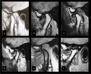Different MRI assessments disclosing previous joint disc displacement, with no reduction in the parasagittal views. One can observe compressive deformation of the joint disc in (a), also during dynamic comparison of the mandibular condylar movement in (b) and (c). Osteophytic formations (d–f), subchondral cyst (d), and severe change in form (f) define the diagnosis of osteoarthritis degenerative alterations in bone components. The presence of hyperintense T2-weighted images defines the diagnosis of effusion in (b–f).