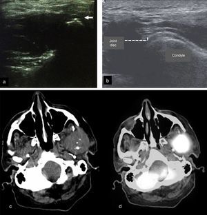 Other imaging techniques. (a) Ultrasound examination of the TMJ25 used during the arthrocentesis assessment. Note the arthrocentesis needle as a hyperechoic point (white arrow). (b) Ultrasound examination of the TMJ showing the joint disc and condyle. (c) Tomographic axial view28 showing mass of soft tissue growth in the left TMJ region extending to the ipsilateral pterygoid region. Infra-temporal space with absence of condylar process, the presence of hyperdense areas, swelling, and asymmetry. (d) PET/CT assessment in axial view28 showing high metabolic activity in the left TMJ region. Images reproduced with permission of the authors’ copyrights25,28 by Elsevier.