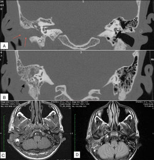 High-resolution coronal computed tomography images of the mastoids (A and B). (A) Erosion of the posterior wall of the external auditory canal (EAC; white arrow) and thickening and enhancement of the soft tissue in the region of the EAC (red arrow). (B) Erosion of the mastoid cortex (black arrow) and destruction of the bony septae. Magnetic resonance imaging of the mastoids (C and D). (C) Axial, T1-weighted image demonstrating infiltration of the soft tissues around the EAC, subcutaneous tissue, and parotid gland. (D) Axial, T2-Flair image showing the tympanic and mastoid cavity, with tissue contrast uptake spreading anteroinferiorly.