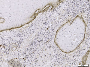 Representative section of lymphatic vessel density using immunohistochemistry with monoclonal antibody against D2-40 (original magnification 200×).