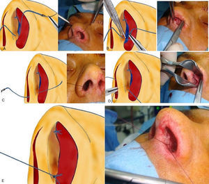 The sequences of the inferior septocolumellar suture.